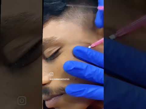 Thread lifting Treatment