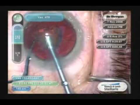 Crystalens Lens Surgery