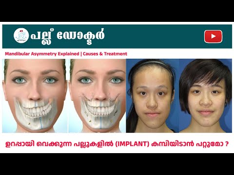 കീഴ്താടിയുടെ വളർച്ച വ്യതിയാനം | Mandibular Asymmetry Explained | Causes & Treatment | Pallu Doctor