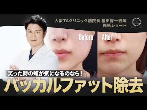 頬のふくらみをどうにかしたい!バッカルファット除去Before・After