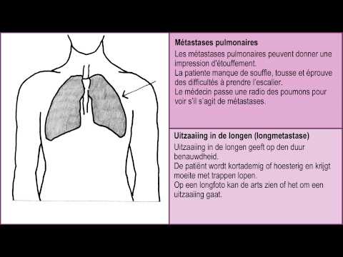 comment guerir des metastases osseuses