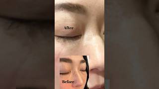 Again spot removal peeling process 🍀 #vancouver #canada #darkspots #peelingtrearment #pigmentation