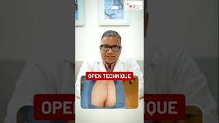 Open Surgery for Pilonidal Sinus #sinus #opensurgery #pilonidalsinus #treatment