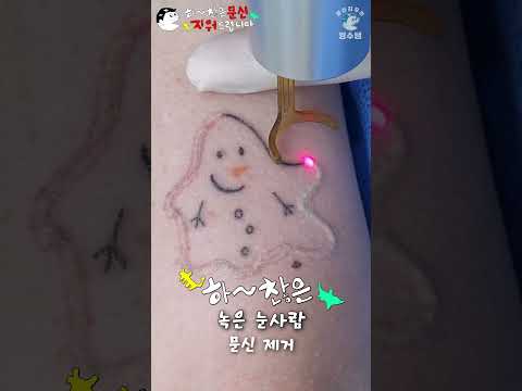 하찮은 녹은 눈사람 문신 제거 [Laser Tattoo Removal]