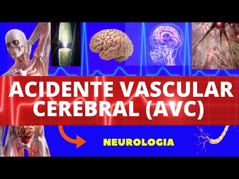 AVC ACIDENTE VASCULAR CEREBRAL (CAUSAS, SINTOMAS, DIAGNÓSTICO E TRATAMENTO) ISQUÊMICO E HEMORRÁGICO