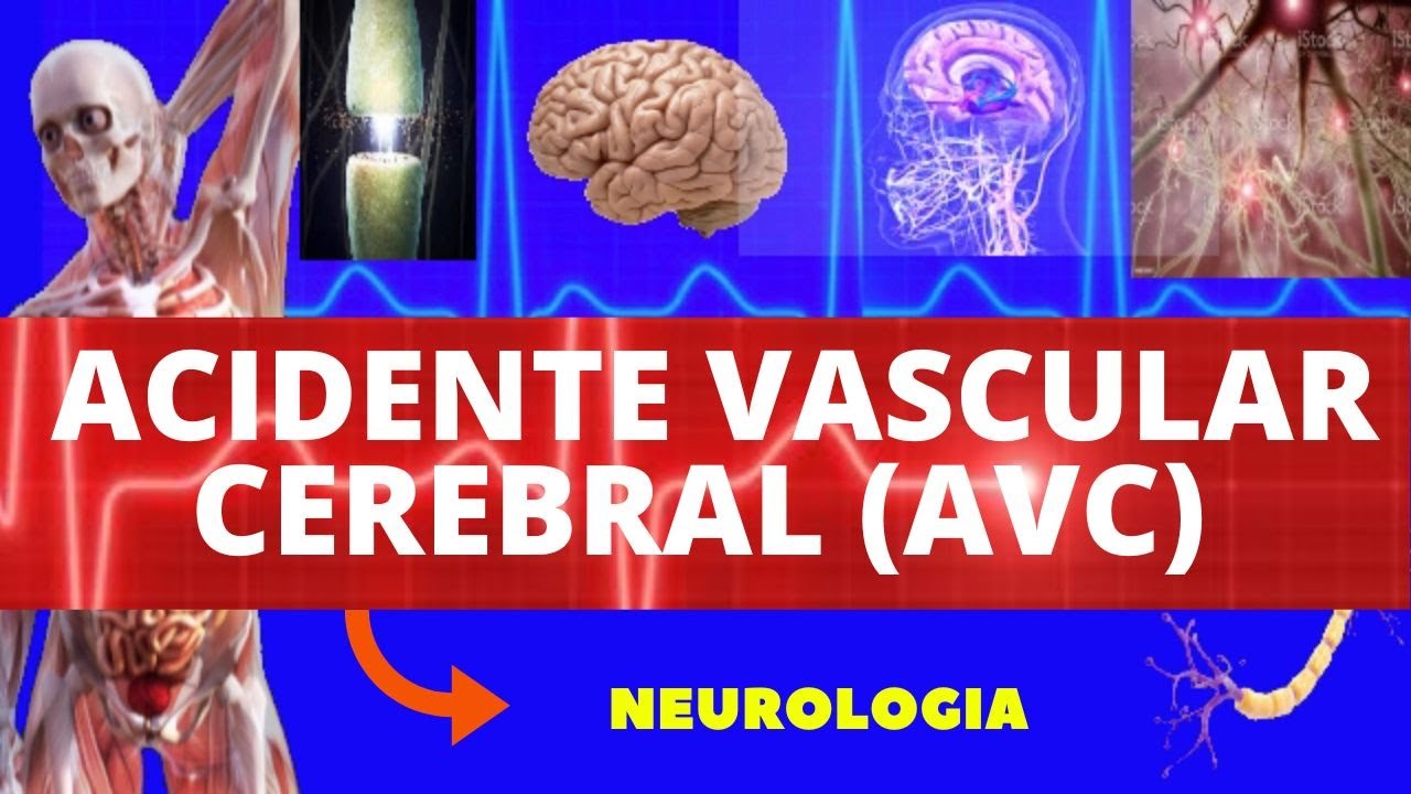 AVC ACIDENTE VASCULAR CEREBRAL (CAUSAS, SINTOMAS, DIAGNÓSTICO E TRATAMENTO) ISQUÊMICO E HEMORRÁGICO