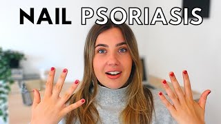 NAIL PSORIASIS TREATMENT AT HOME // psoriasis update and storytime