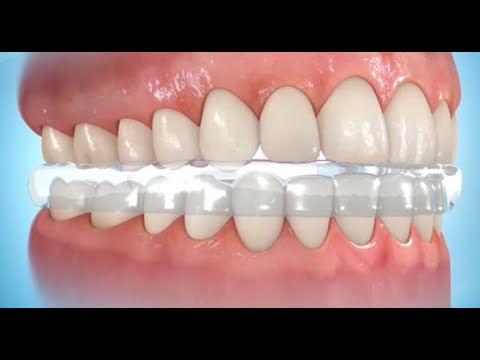 TODO SOBRE LAS FÉRULAS Y EL BRUXISMO