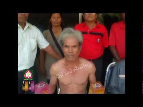 โรคสะเก็ดเงินกล้ามเนื้อ โซเดียมคลอไรด์กลาก
