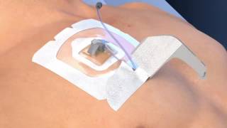 3M Tegaderm CHG IV Securement Dressing | Vitality Medical 3M Tegaderm CHG IV Securement Dressing | Vitality Medical