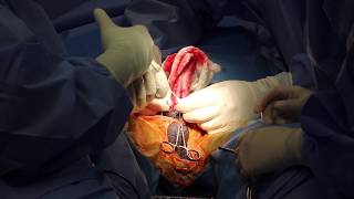 Atlanta's Natural Scar Subcoronal Penile Implant with Circumcision By Dr. Hakky SUHD 4K