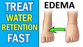 HOW to Get Rid of WATER RETENTION in the Body - NATURALLY & FAST