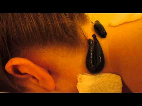 Holistic Therapy - Leeches Treatment Dublin , Ireland , Headache , migraine