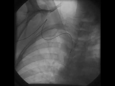 Transradial Access - Video 5.10