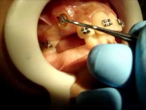 Canine Exposure With Diathermy (Electrocautary) And Orthodontic Traction