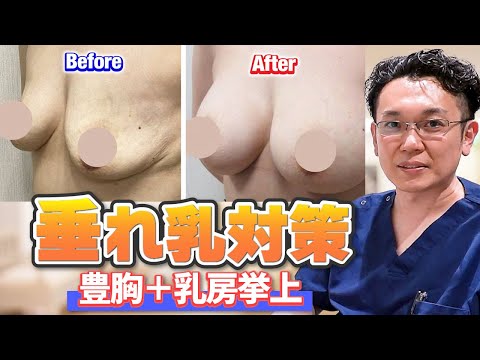 胸のハリを取り戻す”乳房挙上術”でバストアップ！専門医師が解説します| 東京美容外科