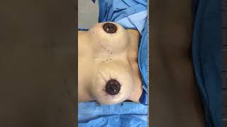 Dr. Reynolds - Breast Augmentation/peri-areolar lift Final