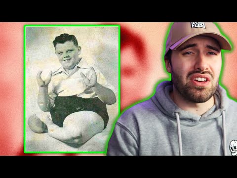 Lobster Boy - Cirus Act Turned Sadistic Killer