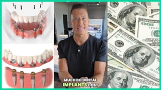 How Much Do Dental Implants REALLY Cost in 2025? Full Mouth Pricing Revealed - Affordable Payment