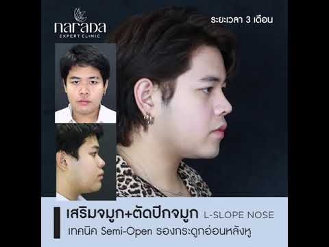 L-Slope Nose เสริมจมูกผู้ชาย สโลปแบบธรรมชาติ +ตัดปีกจมูก เทคนิค Semi-Open รองกระดูกอ่อนหลังหู  L-Slope Nose เสริมจมูกผู้ชาย สโลปแบบธรรมชาติ +ตัดปีกจมูก เทคนิค Semi-Open รองกระดูกอ่อนหลังหู