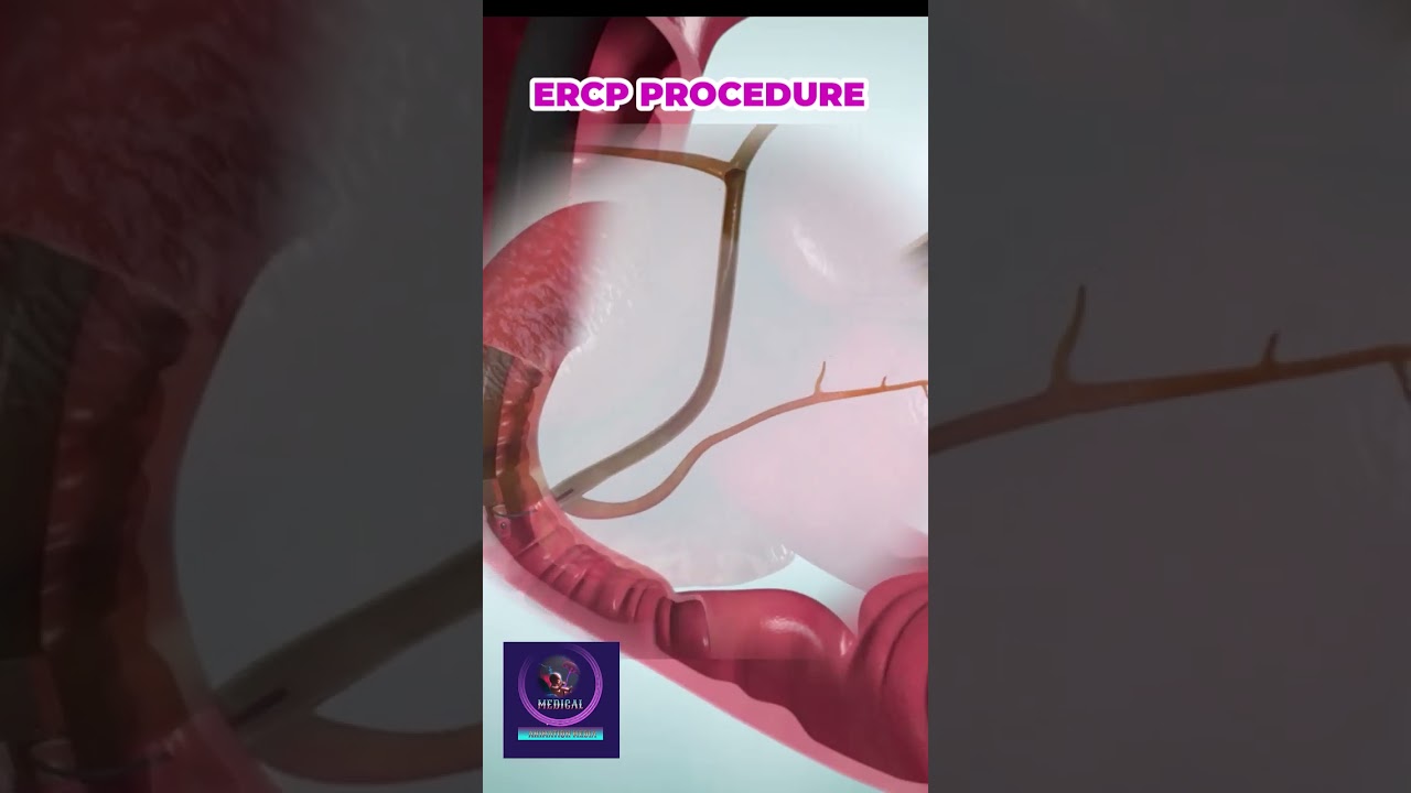ERCP Procedure: for Bile Duct Obstruction Removal