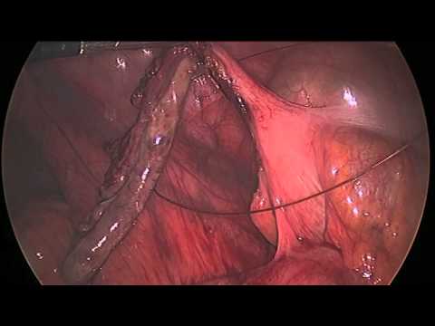 Laparoscopic Appendectomy