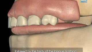 Normal Swallow affecting Dental & Facial Development