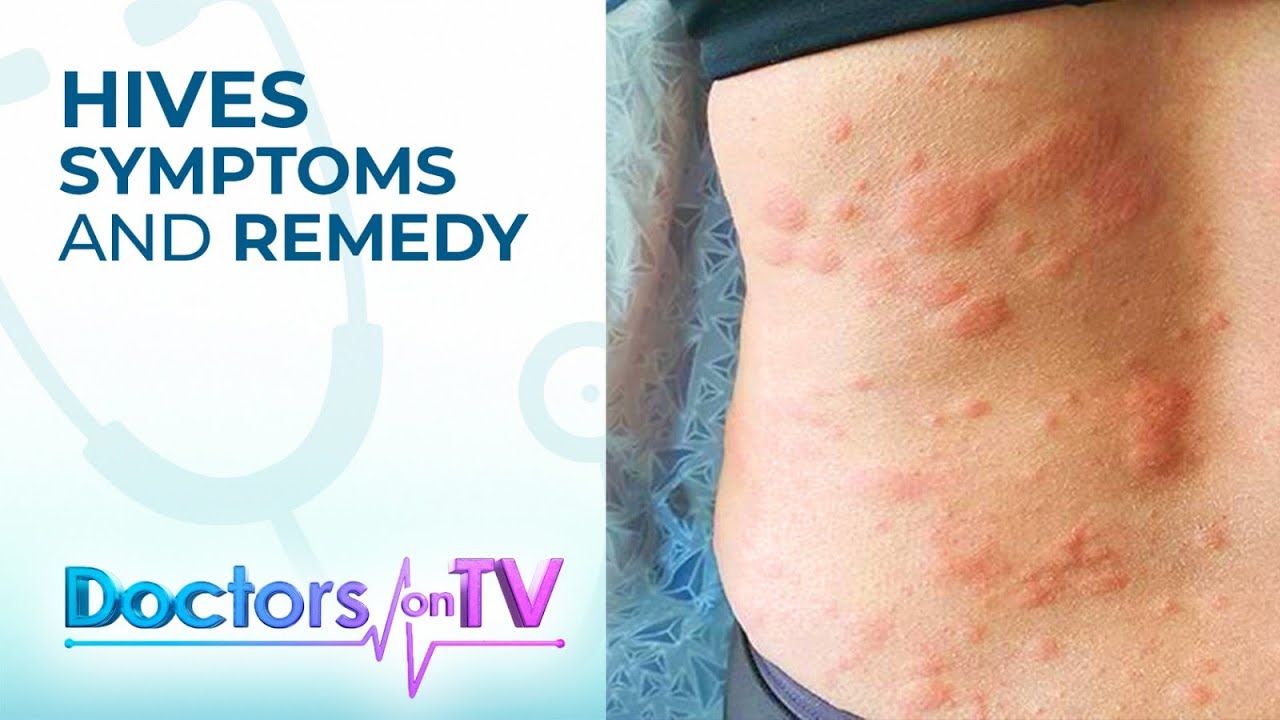 Hives Symptoms and Remedy | DOTV