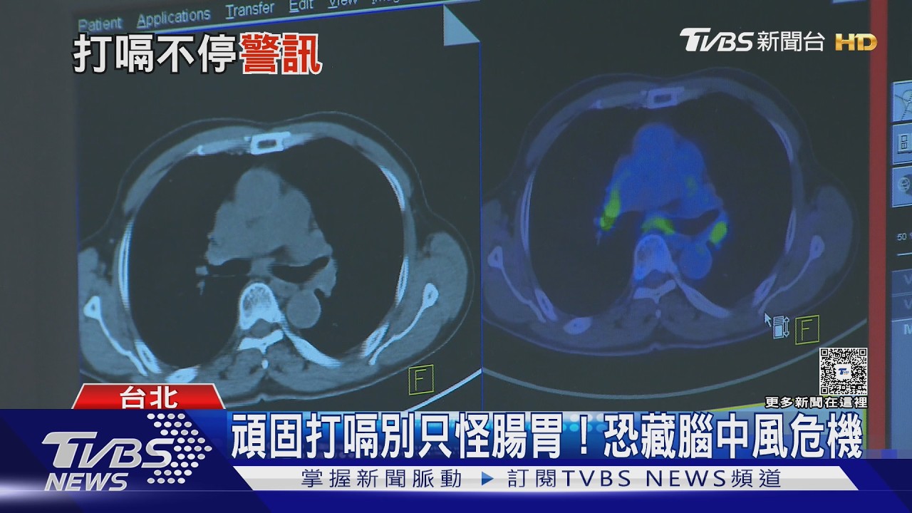 打嗝超過48小時...恐罹「這重大疾病」!醫師警告:合併頭暈、走不穩快就醫!