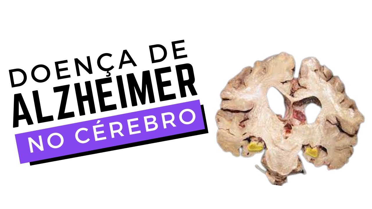 SINTOMAS, CAUSAS E FISIOPATOLOGIA DA DOENÇA DE ALZHEIMER