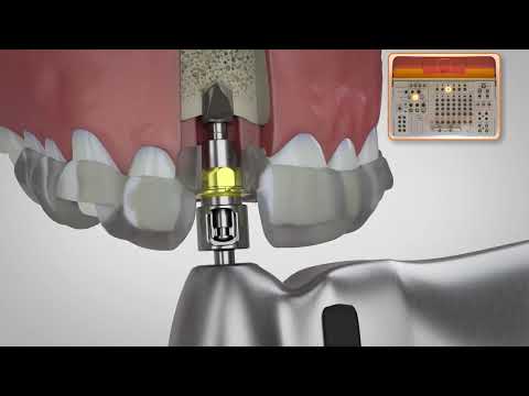 BioHorizons Pro Surgical Kit Drilling Sequence [Keyless Guided Surgery]