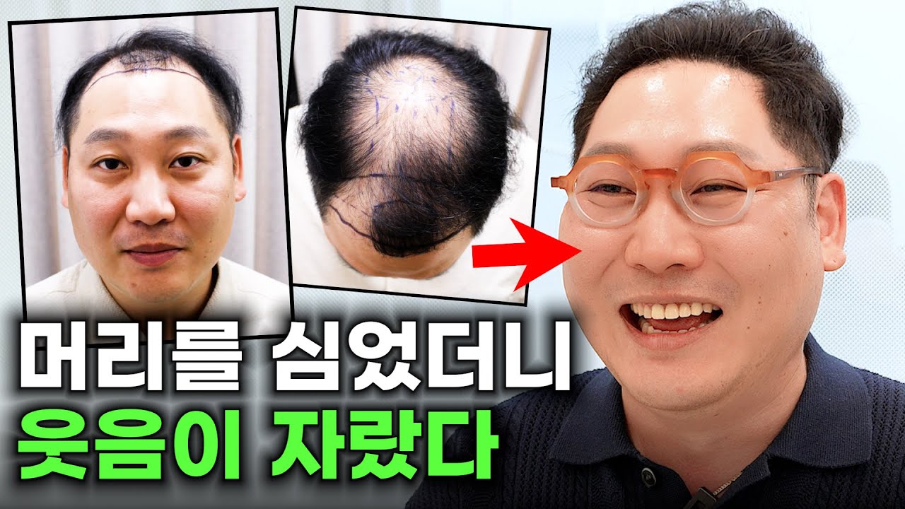 모발이식은 40대 아저씨도 웃상으로 만든다 | 모발이식 1년 후기