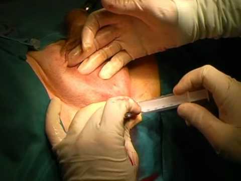 Regulowana Terapia Nietrzymania Moczu (Proact) - Rozwój Techniki Chirurgicznej
