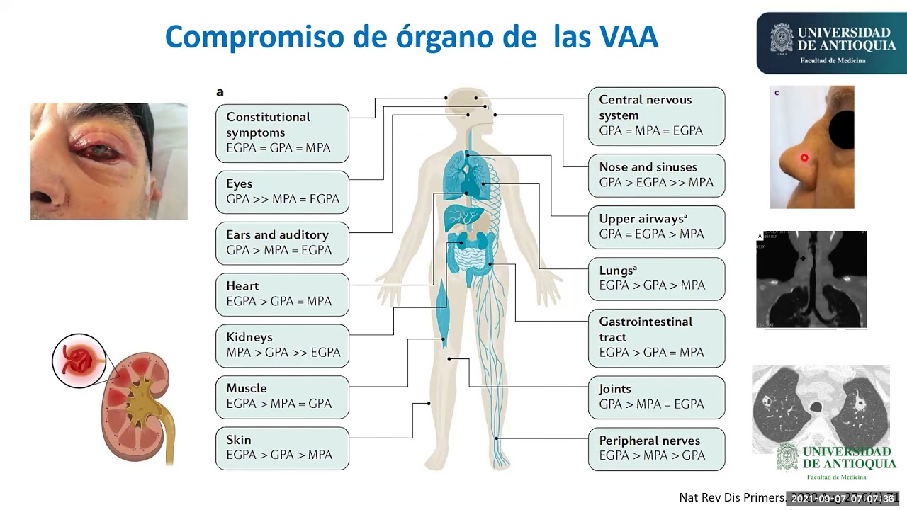 Guía para el Tratamientos de la Vasculitis asociada a ANCA - Dr. Andrés Ramírez