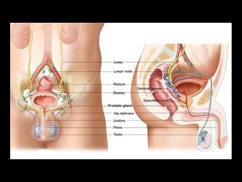 Cancro della prostata è la prostatectomia Trattamento di prostatite cognac