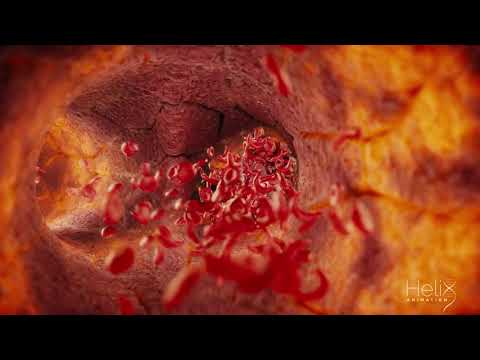 3D animation of a Clogged blood vessel due to a Sickle cell disease