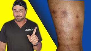 Easy Home Remedy for Dark Spots on Your Body