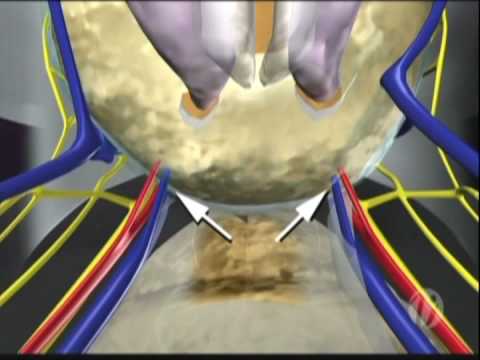 Introduction To The Prostatectomy For Prostate Cancer