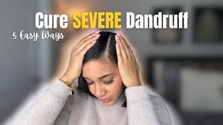 5 Easy Ways To Cure Severe Dandruff: Seborrheic Dermatitis