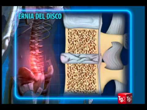 Trattamento sanatorio di articolazioni delle gambe Trattamento di ernia spinale in Penza