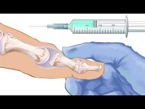 Artrózis kezelése injekcióval, RenehaVis hialuronsav kezelés