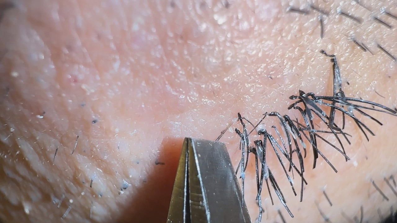 Plucking facial hair 1427 顎髭抜き