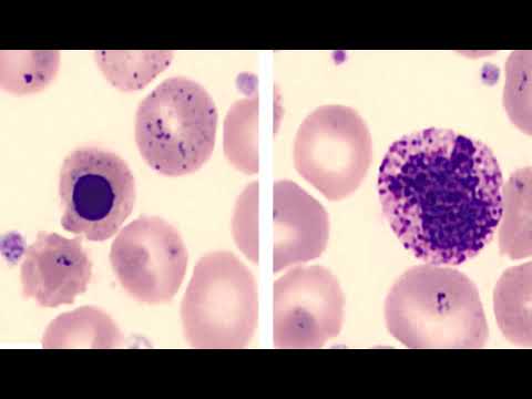 Metal Toxicity for the USMLE Step 2