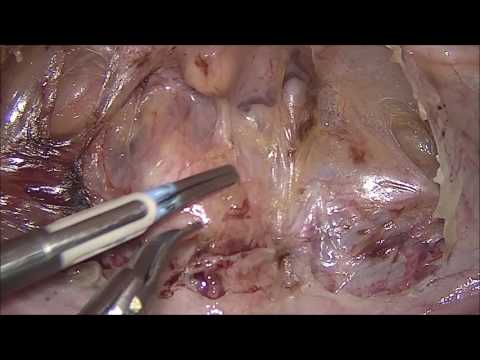 Lateral Suspension Technique For Uterine Prolapse And Cystocele Repair