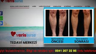 BURSA VARİS TEDAVİ MERKEZİ  | Dr.Ögr üyesi. Op.Dr. Yunus Keser YILMAZ 