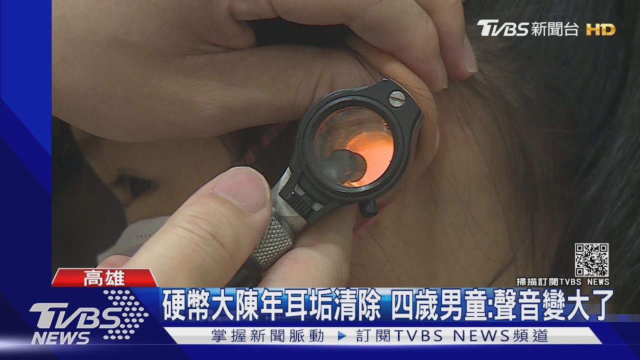 四歲男童清出硬幣大耳垢 家長驚:難怪之前調皮不專心