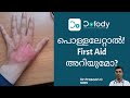 പൊള്ളലേറ്റാൽ Ice, Paste മതിയോ? |  Best Burn Ointment & First Aid of Minor Burns | Malayalam