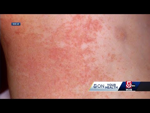 Treating those hot weather skin rashes and when to worry