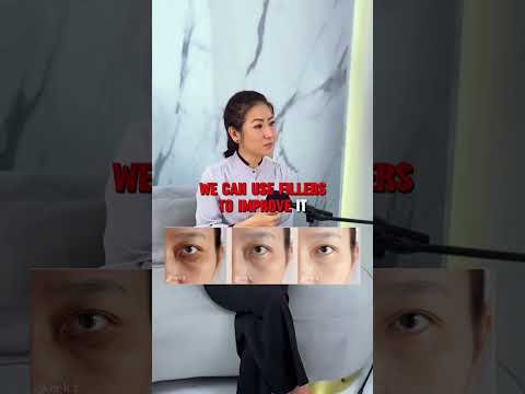 Where to Inject HA Filler vs Biostimulator | Best Areas for Different Fillers (Malaysia Guide)