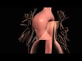 Aortic Aneurysm And Aortic Dissection